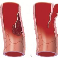 DISSECÇÕES DAS ARTÉRIAS CERVICAIS